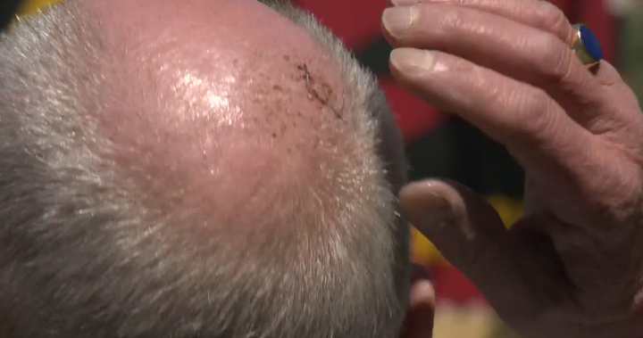 70-year-old victim of random Vancouver assault says attacker body slammed him - BC [Video]