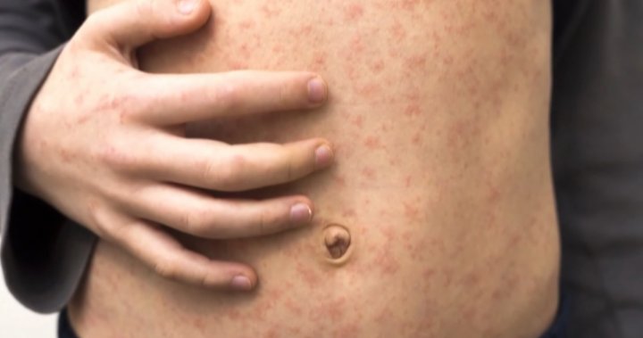 Measles likely to grumble into summer as cases continue to surge - National [Video]