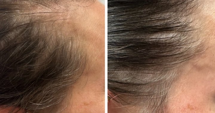 Saskatoon Hair Loss Clinic forced to move because of an oversight in zoning [Video]