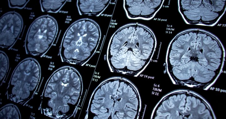 New Brunswick launches info line as part of mystery neurological illness probe – New Brunswick [Video]