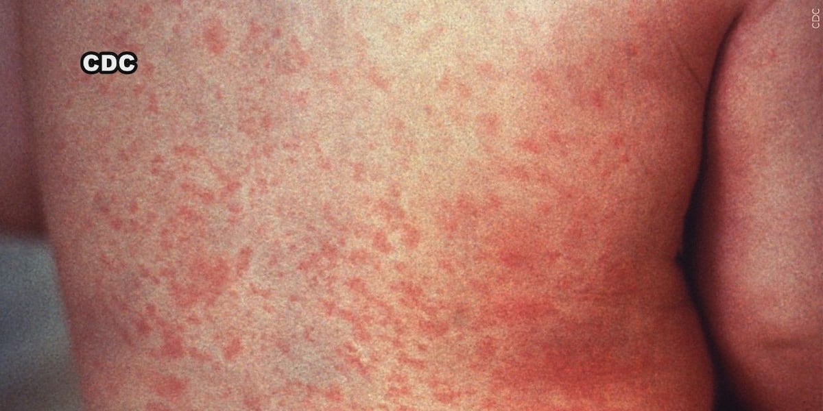 Measles cases in Arizona raise concerns over indigenous immunization rates [Video]