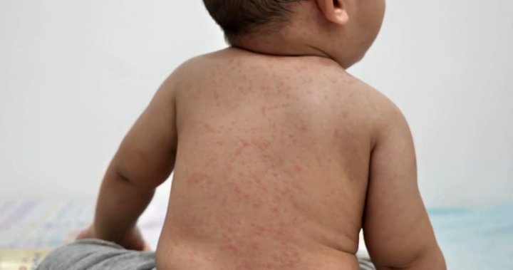 Rampant measles spread in northern Alberta prompts another standing exposure advisory [Video]